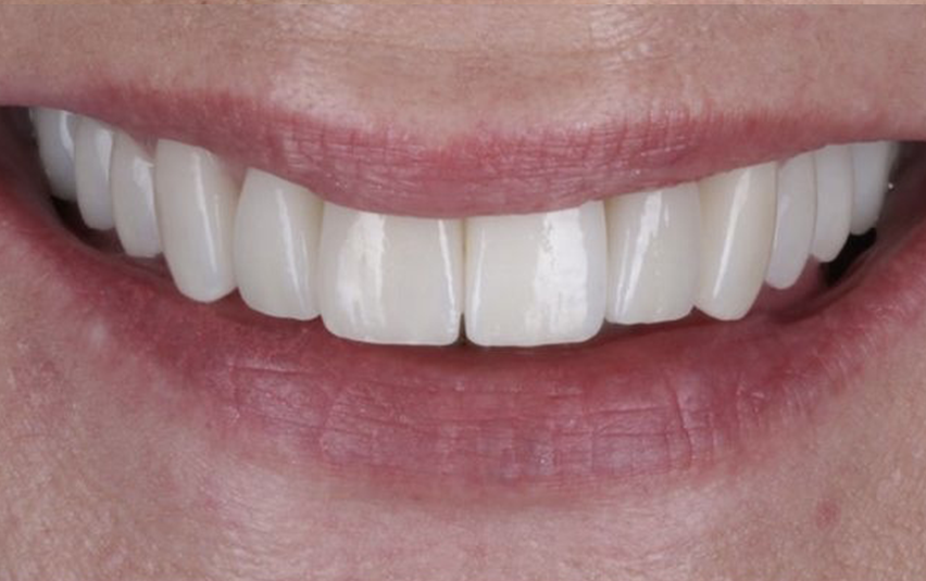 After - Littleport Dental