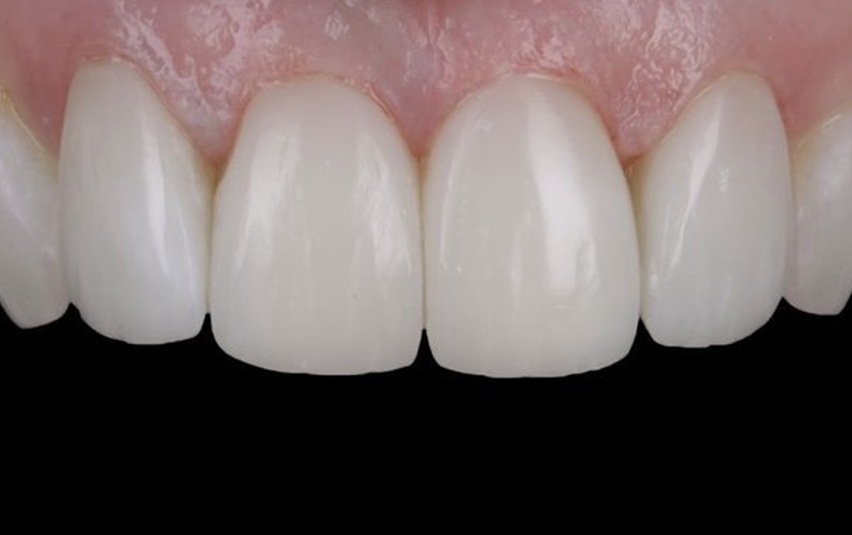 After - Littleport Dental